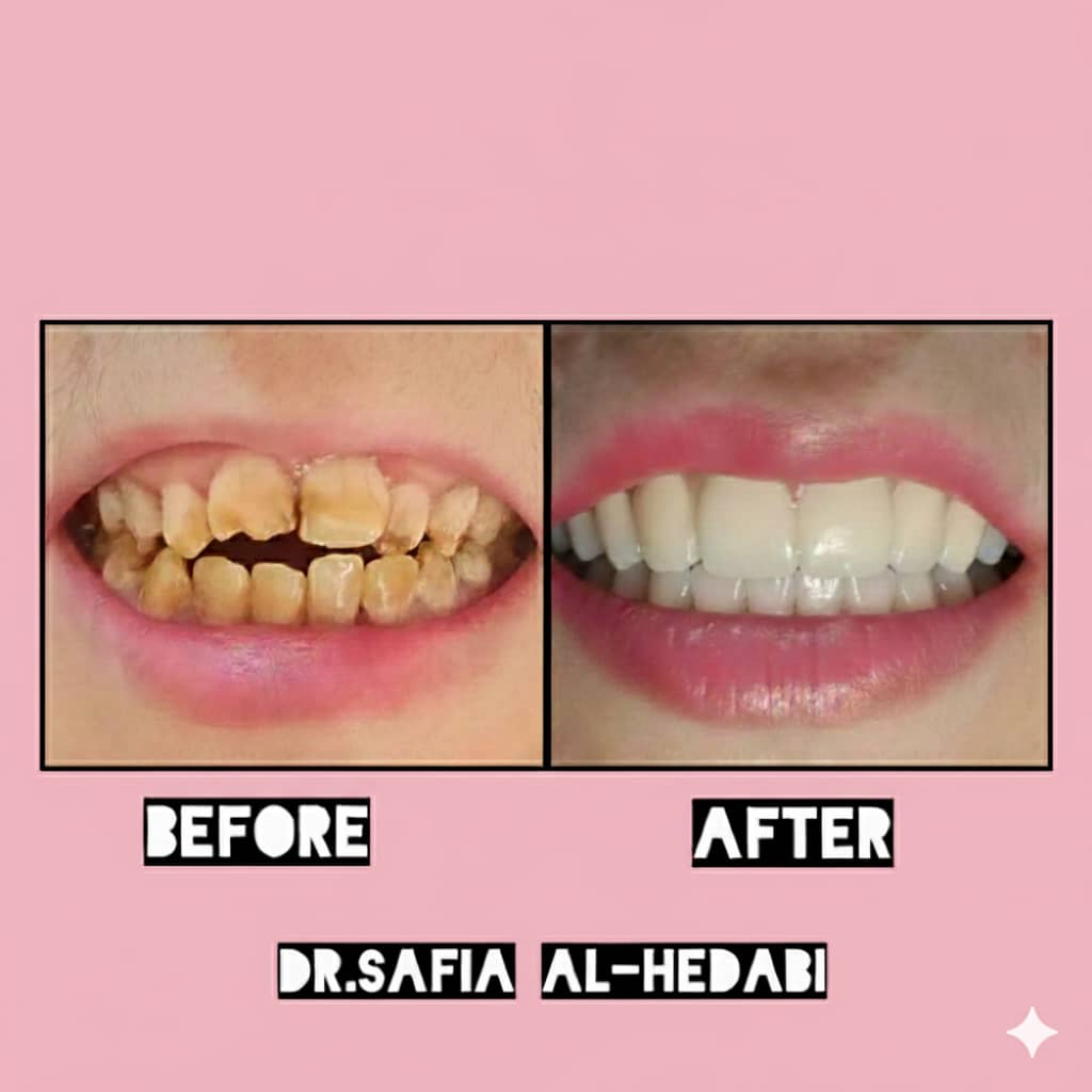 صنع إبتسامة جديدة وجميلة عن طريق التلبيسات